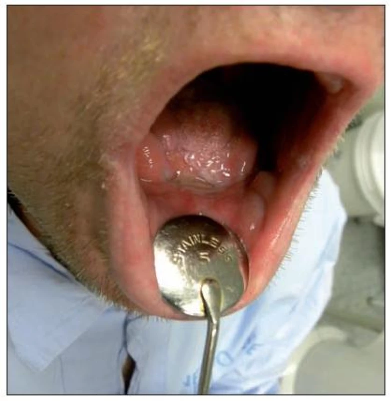 Sarkom jazyka (stav hojení ústní dutiny 6 týdnů po operaci)