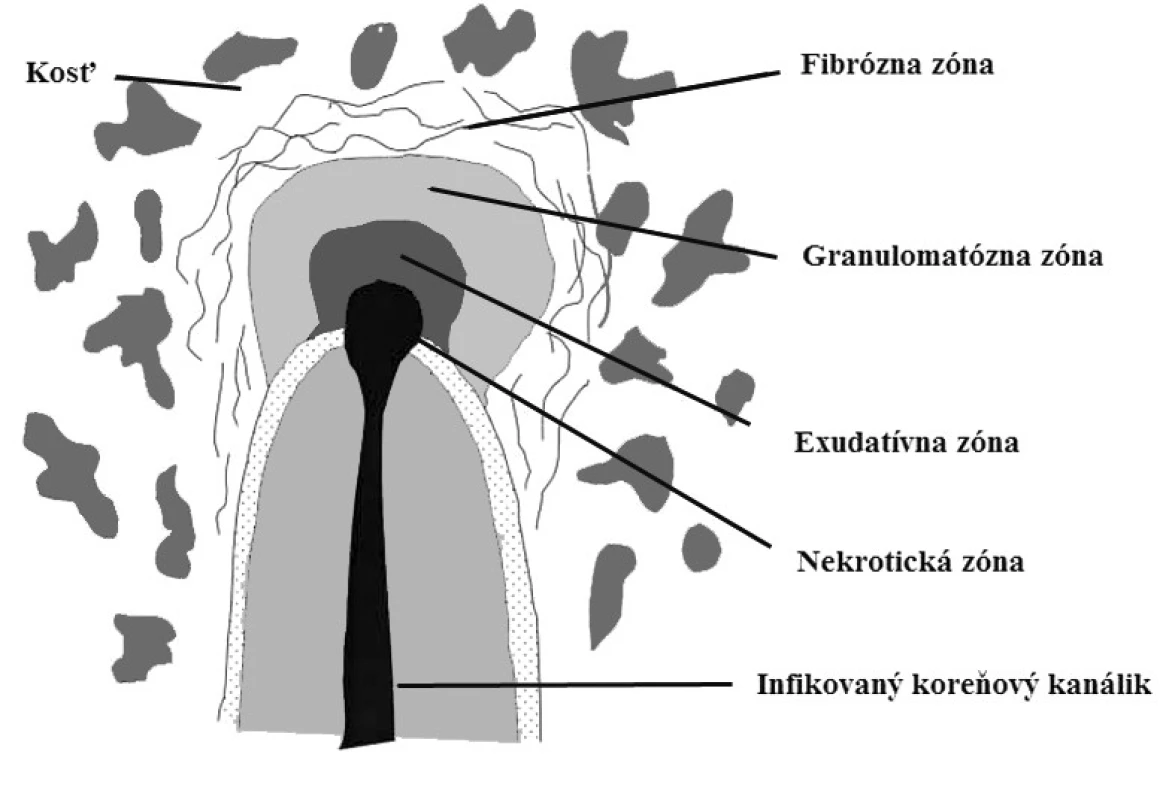 Histologická štruktúra chronickej periapikálnej zápalovej lézie [9]
Fig. 2. Histological structure of a chronic periapical inflammatory lesion [9]