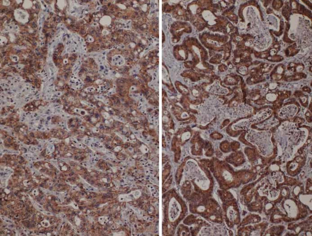 Porovnání exprese E-cadherinu v nádorovém parenchymu kolorektálního karcinomu.