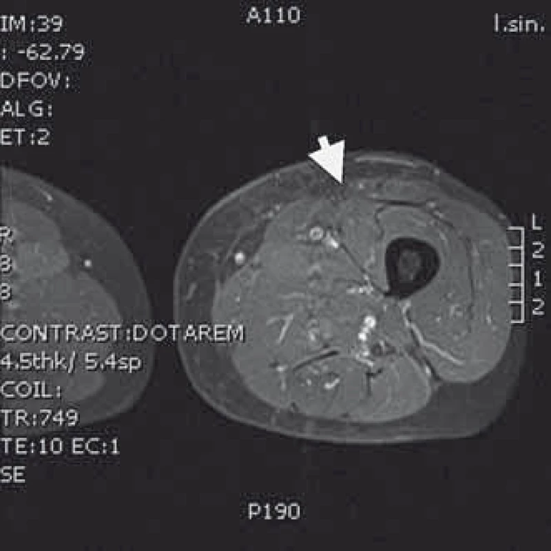MRI T1 s kontrastem – obraz levého stehna bez přítomnosti nádorové tkáně po radikální resekci následované radioterapií a brachyterapií.