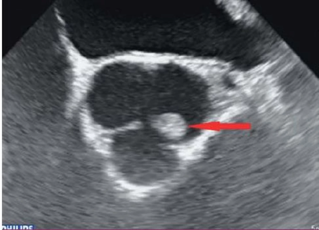 Papilární fibroelastom na levém koronárním cípu aortální chlopně (transtorakální echokardiografie – parasternální projekce na krátkou osu).