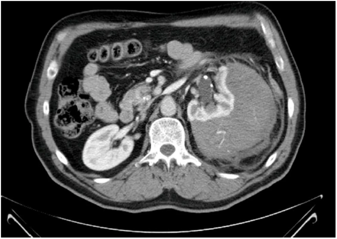 CT vyšetření s patrným hematomem a leakem kontrastní látky z ledviny
Fig. 1 CT scan with an apparent haematoma and leakage of contrast medium from the kidney