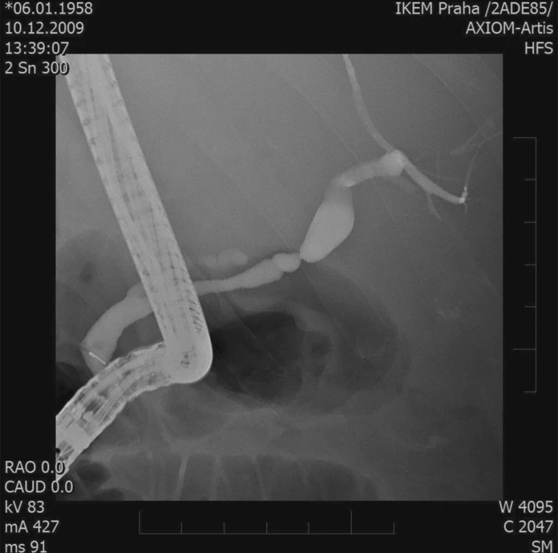ERCP – stenóza žlučovodu
Fig. 2. ERCP – biliary duct stenosis