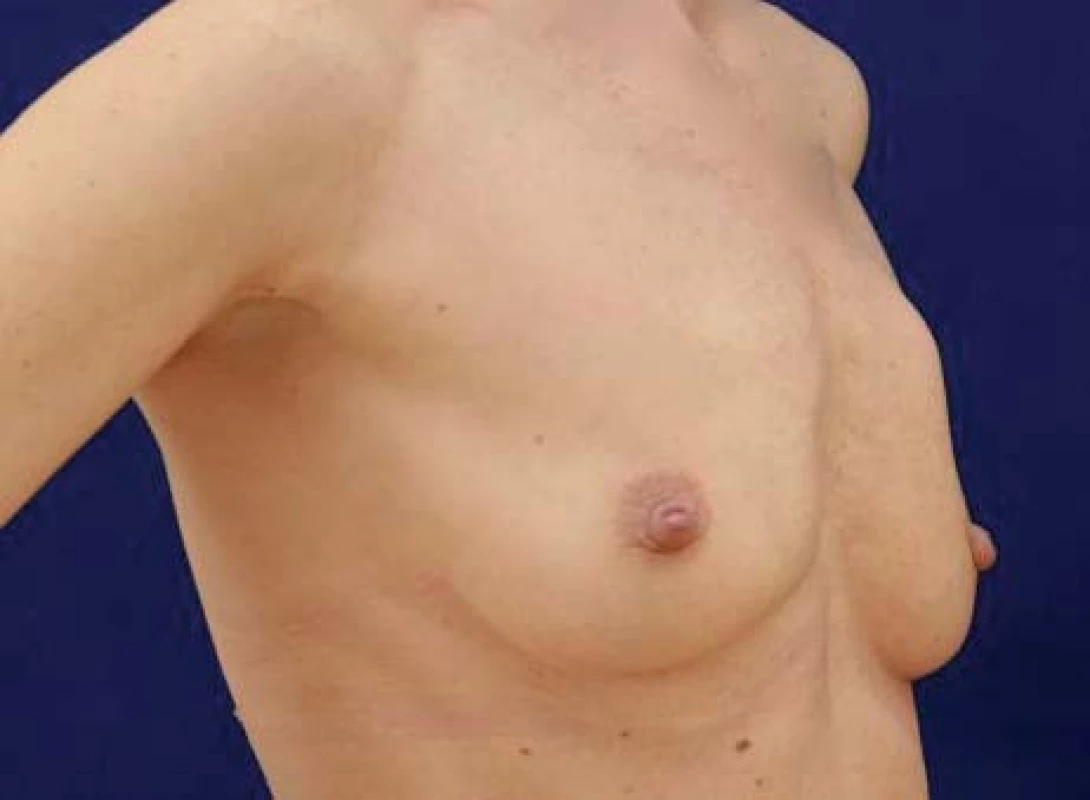 Viditelné kožní vyklenutí podmíněné karcinomem v oblasti horních kvadrantů levého prsu.