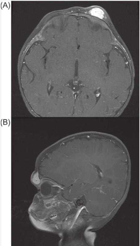 Magnetická rezonance na obr. zobrazuje v T1 poskontrastně axiální (A) a předozadní (B) dobře ohraničenou, jasně svítící lézi levého čela a horního víčka