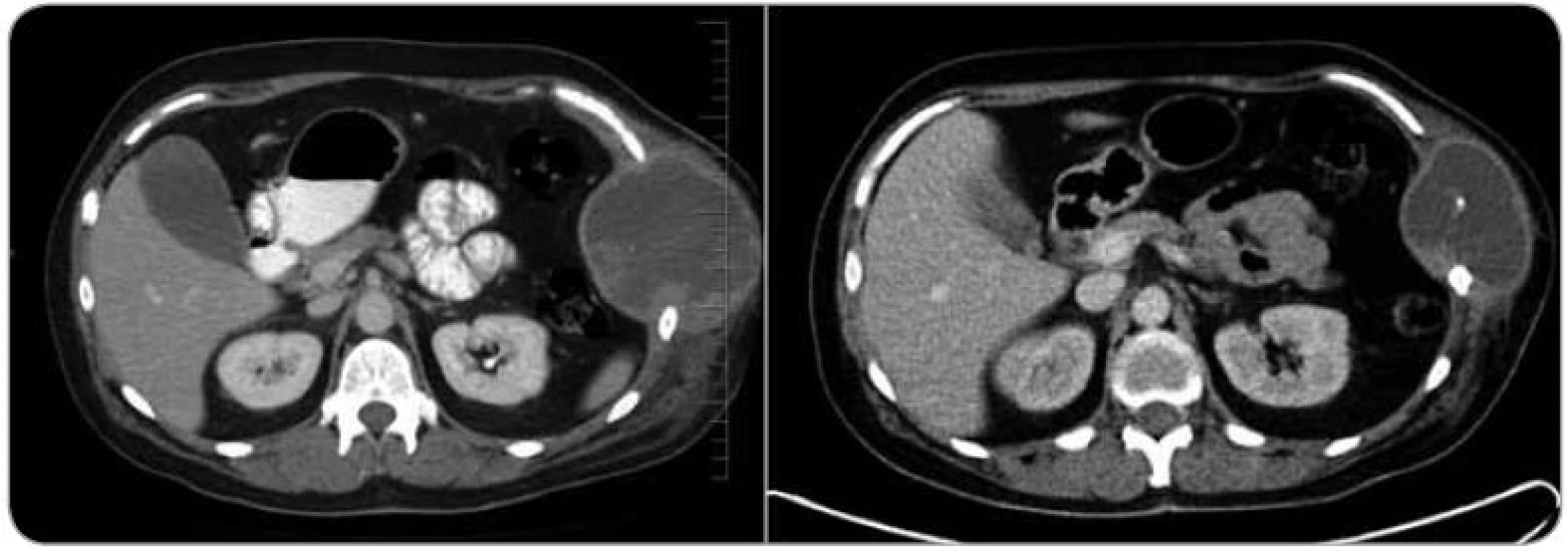 Srovnání CT vyšetření z ledna 2012 (vlevo) a z dubna 2012 po aplikaci tří cyklů neoadjuvantní chemoterapie (vpravo). Je znatelné zmenšení tumoru hrudní stěny po léčbě.