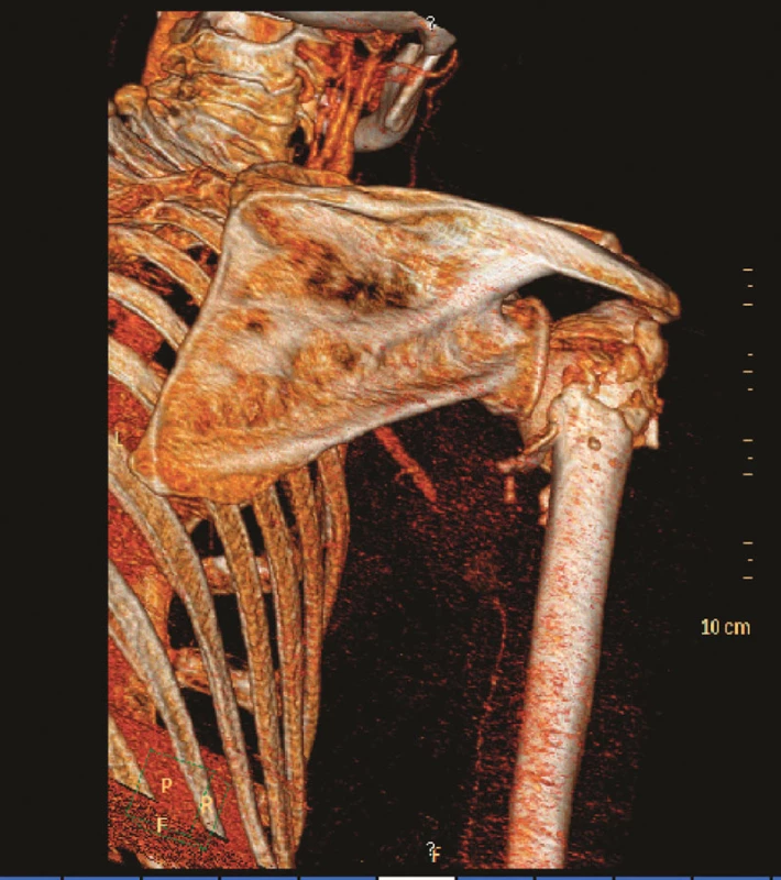 3D CT angiografie s patrnou okluzí 3. segmentu arteria axillaris
Fig. 2. 3D CT angiography depicting occlusion of the 3rd segment of the arteria axillaris