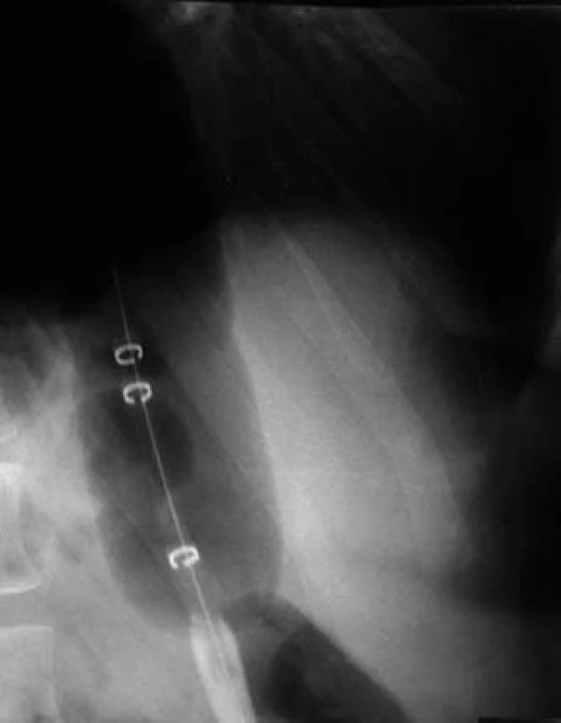 RTG snímka zobrazujúca insufláciu balónika počas pneumatickej dilatácie. Tlak dolného pažerákového zvierača spôsobuje zúženie balónika v začiatočnej fáze jeho insuflácie (A). Ku koncu pneumatickej dilatácie zúženie balónika kompletne zmizne (B).
Fig. 3. X-ray imaging showing insufflation of the balloon during pneumatic dilation. Lower oesophageal sphincter pressure forms a waist in the balloon during the initial phase of insufflation (A). The waist in the balloon has completely disappeared at the end of the pneumodilation procedure (B).