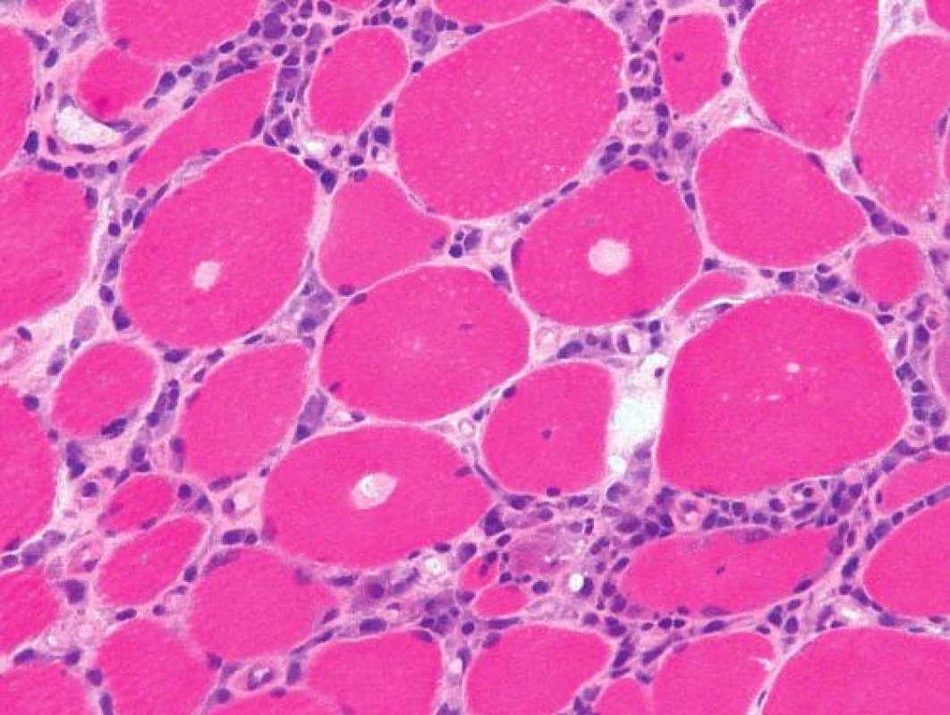 Objemné intracytoplazmatické eozinofilní inkluze byly zřetelné v mnoha vláknech už na úrovni světelného mikroskopu. Barvení izopentanem zmraženého řezu hematoxylinem a eozinem, originální zvětšení 400x.