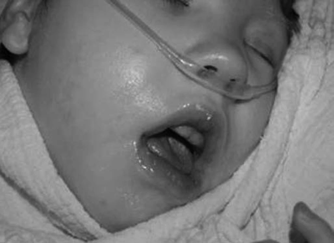 Oxygenoterapie infaustně nemocného dítěte.