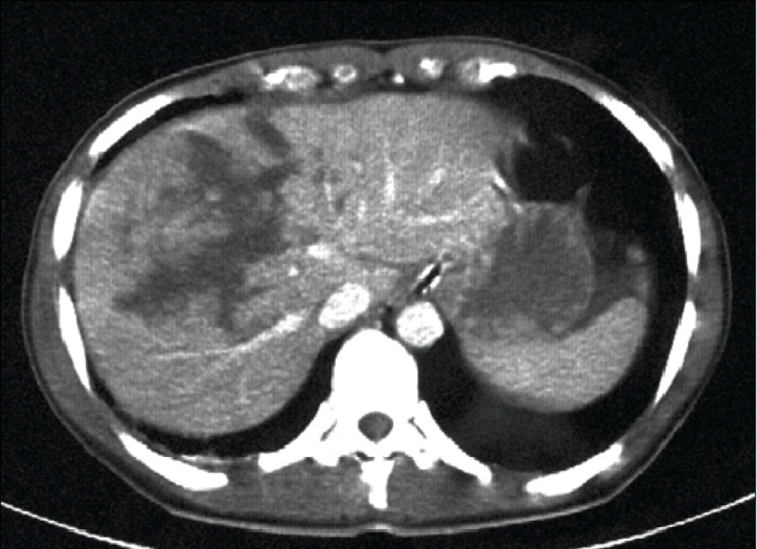 CT snímek jater s nálezem poranění Gr. III. u zraněného léčeného neoperačně