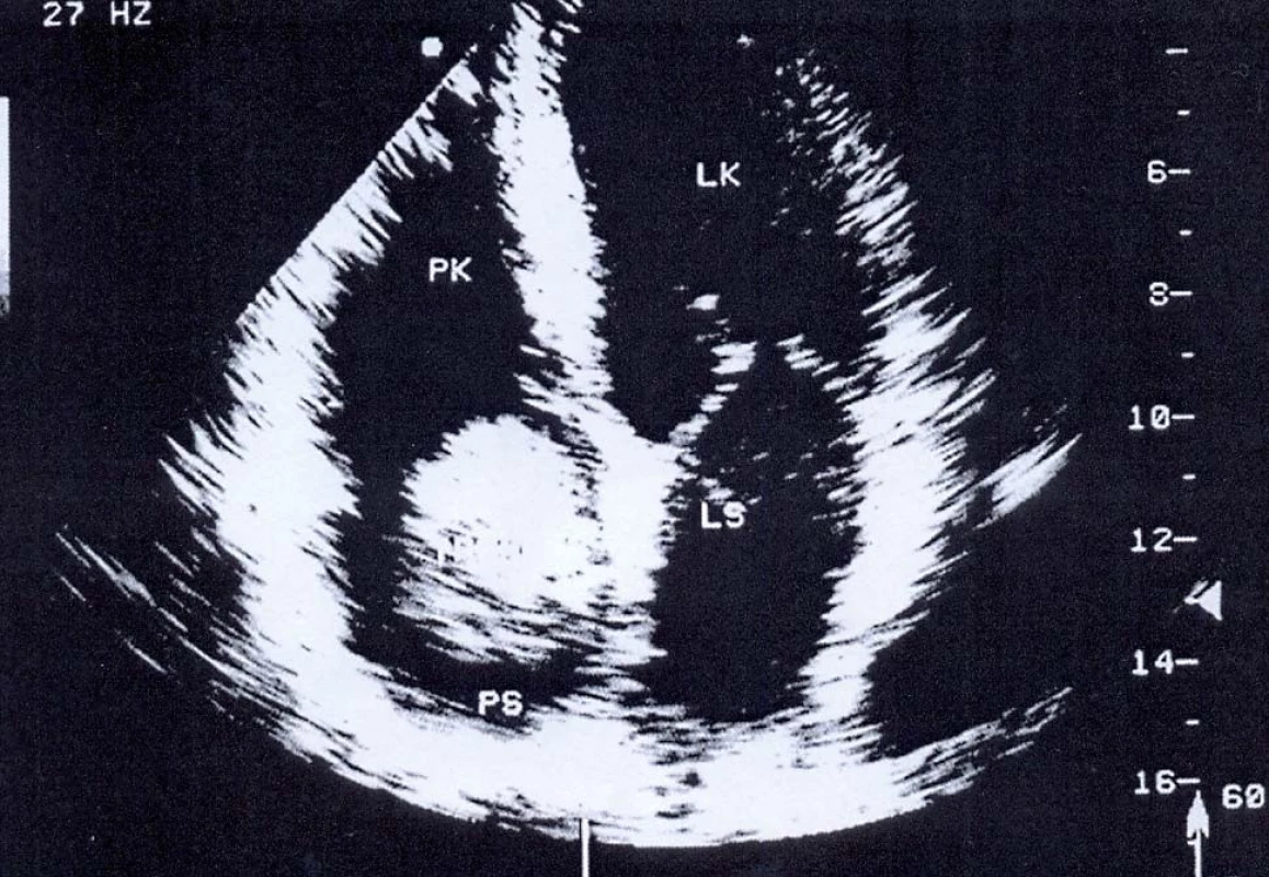 Sonografie – kulovitý trombus v pravé srdeční síni (část činkovitého trombu).