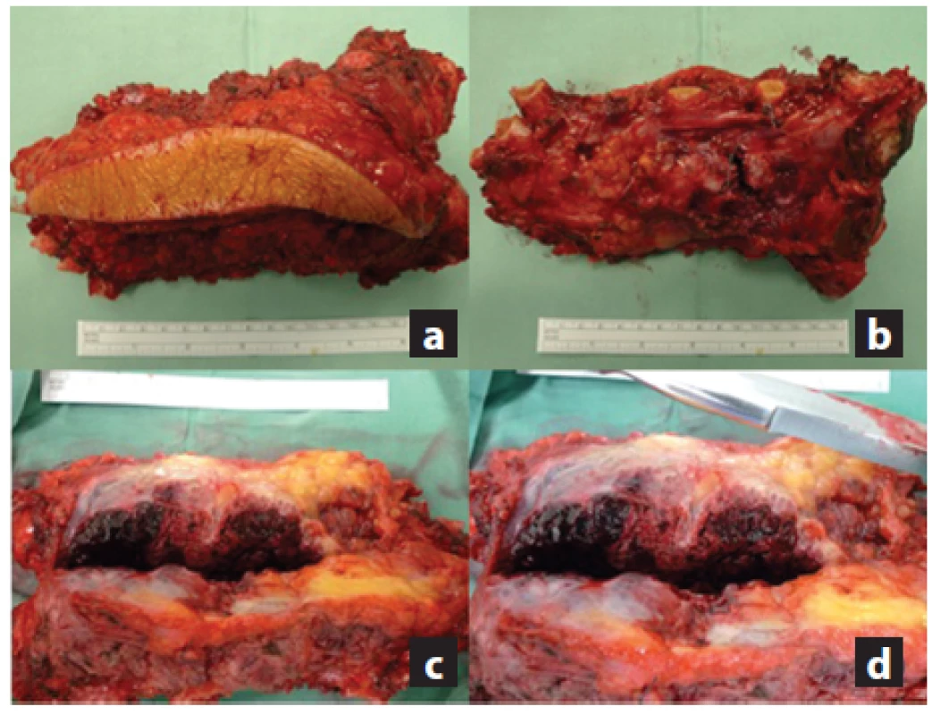 a,b,c,d: a) Snímek preparátu resekátu sterna z ventrální kožní strany; b) Snímek preparátu s viditelnými resekovanými částmi žeber z jeho dorzální strany; c) Řez exstirpované metastázy renálního karcinomu s lokální destrukcí a prokrvácením ; d) Detail lokální destrukce.
Fig. 7 a,b,c,d: a) Picture of specimen from its ventral skin side; b) Picture of specimen with visible resected parts of ribs from the dorsal side; c) Postoperative image of specimen showing local destruction and bleeding; d) Detail of local destruction.