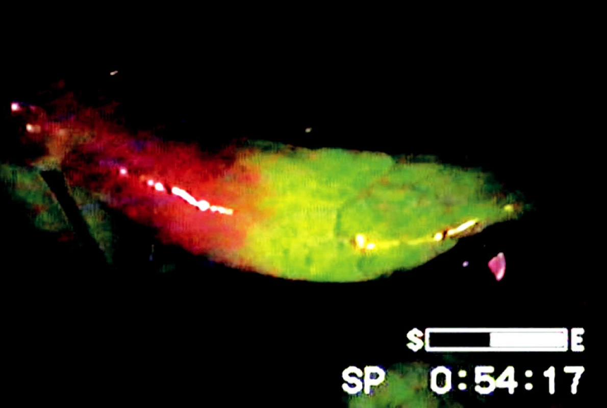 Hranice ischemie střeva vymezená fluoresceinem a UV světlem
Fig. 5. The border of intestinal ischemia marked by fluorescein dye and ultraviolet light