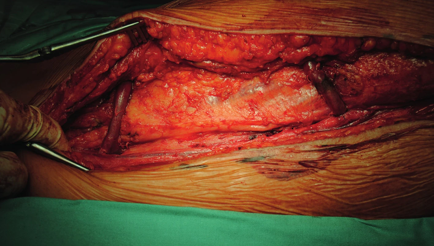 End to side anastomóza mezi graftem a arteria femoralis superficialis
Fig. 2: End to side anastomosis between graft and superficial femoral artery