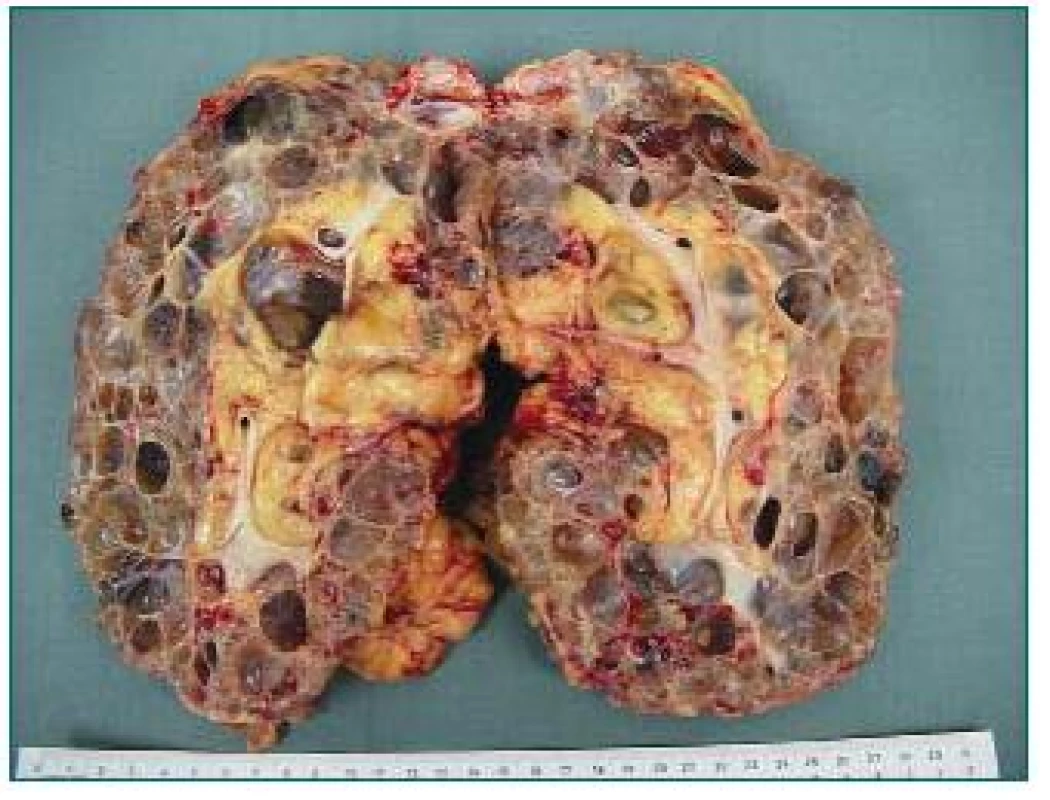 Velká polycystická ledvina (3,8 kg) s mnoha prokrvácenými cystami. Odstraněna z důvodu nedostatku místa pro transplantát před zařazením pacienta do WL.