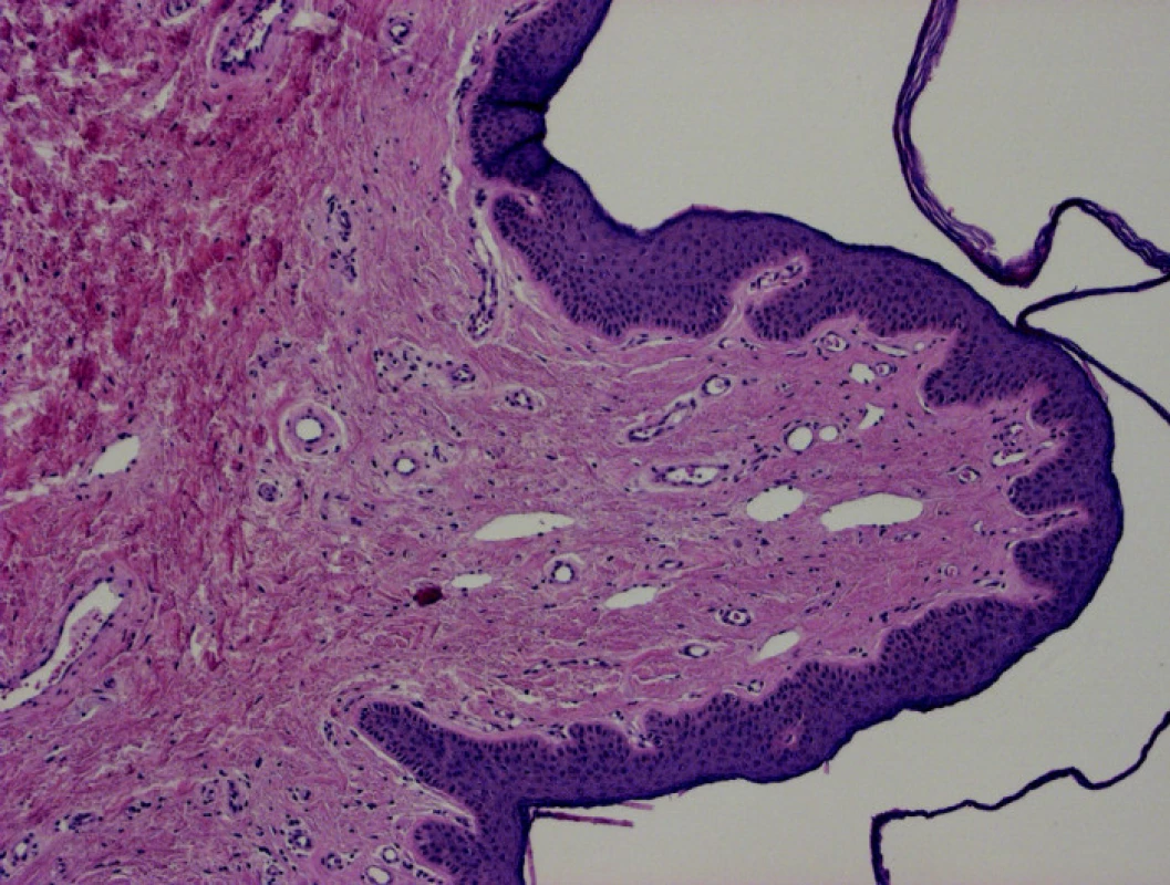 Papillae coronae glandis, histologcký nález – angiofibrom (HE-25x).