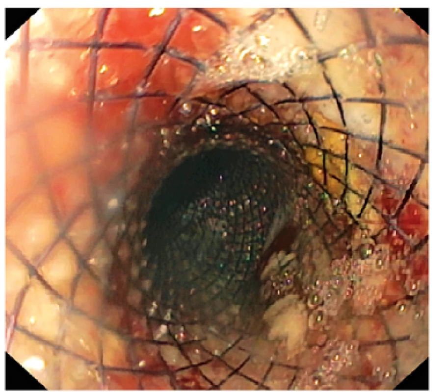 Endoskopický pohled do stentu uloženého přes místo insuficience anastomózy