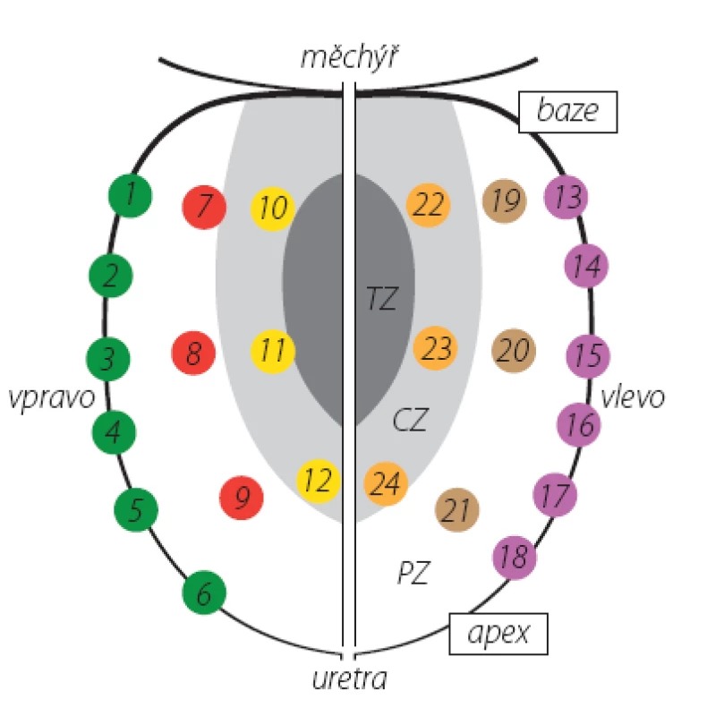 Schéma rozmístění vzorků při saturační biopsii prostaty
TZ – tranzitorní zóna, CZ – centrální zóna, PZ – periferní zóna
Fig. 1. Localization of biopsy cores in saturation prostate biopsy
TZ – transition zone, CZ – central zone, PZ – peripheral zone