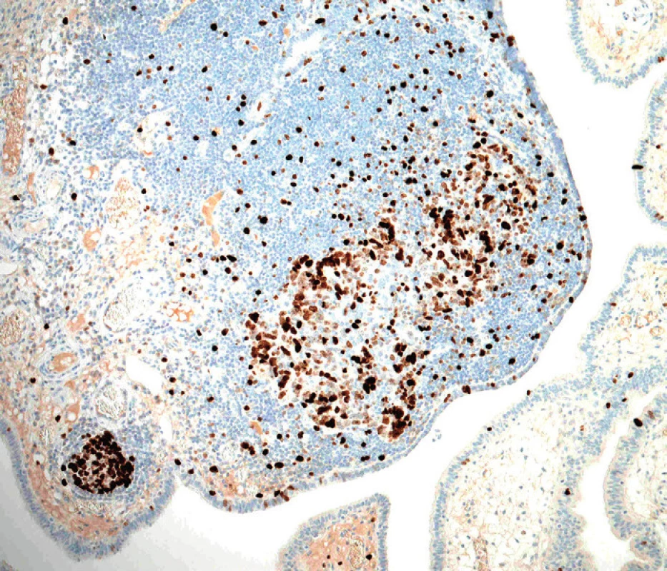 Vysoká proliferační aktivita nádorových buněk při průkazu proliferačního markeru Ki-67. Srovnej s minimální proliferační aktivitou normálního tubárního epitelu v okolí (původní zvětšení 100×)