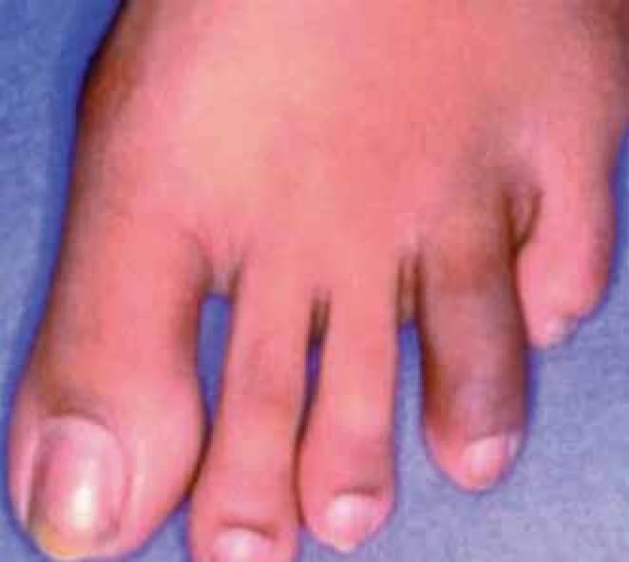 Daktylitida 4. prstu nohy.