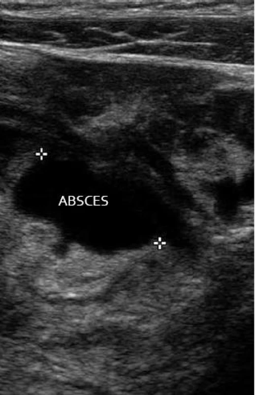 Komplikace divertikulitidy – mezikličkový absces.
Fig. 13. Complications of diverticulitis – interloop abscess.