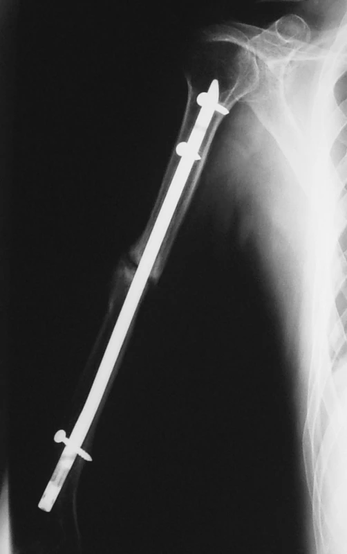 RTG obraz pakloubu diafýzy pažní kosti po nitrodřeňové osteosyntéze hřebem UHN
Pic. 4. X-ray of the pseudoarthrosis of humeral shaft fracture after intramedullar nailing