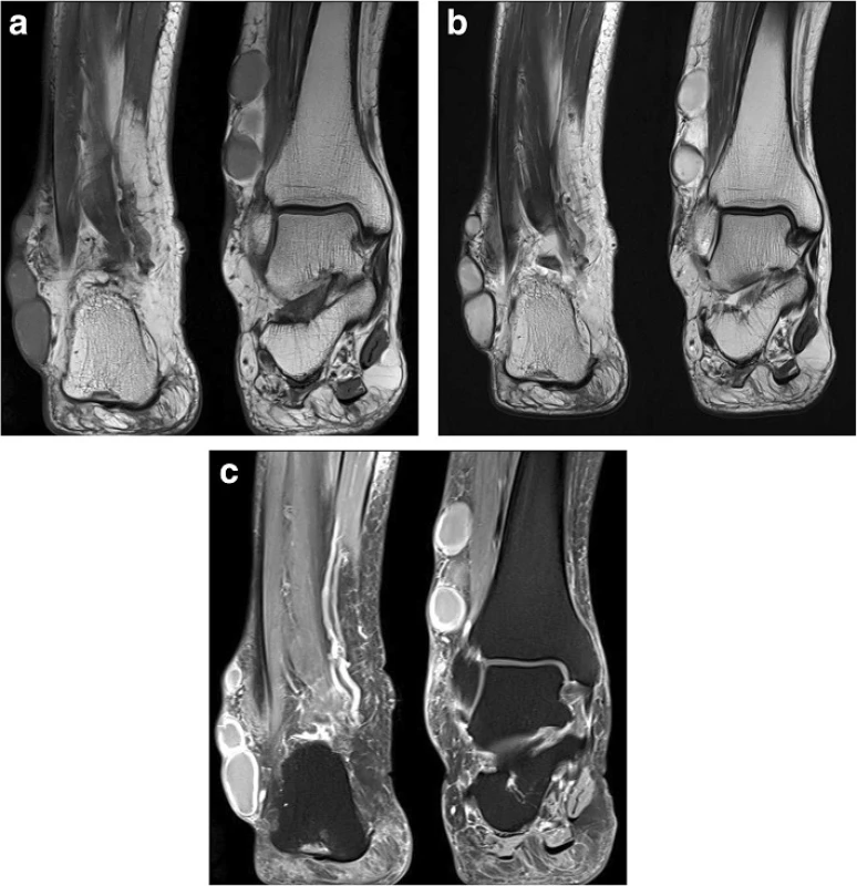 Magnetic resonance imaging of the right ankle at admission: (a) T1-weighted, (b) T2-weighted, and (c) fat-suppressed T1-weighted images