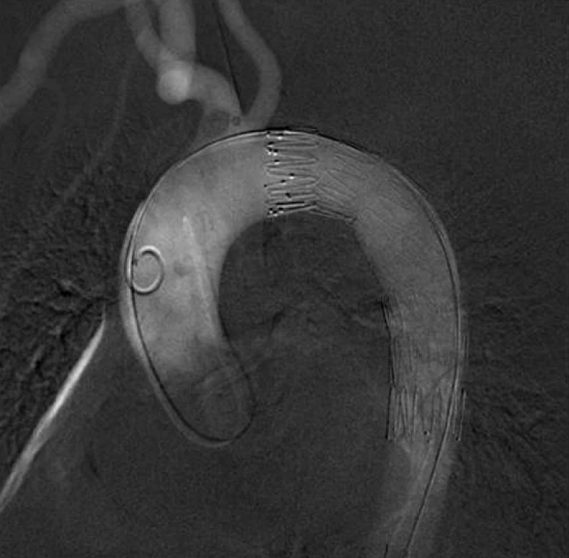 Digitální subtrakční arteriografie- finální uložení endograftu
Fig. 2: Digital subtraction angiography – the final endograft position