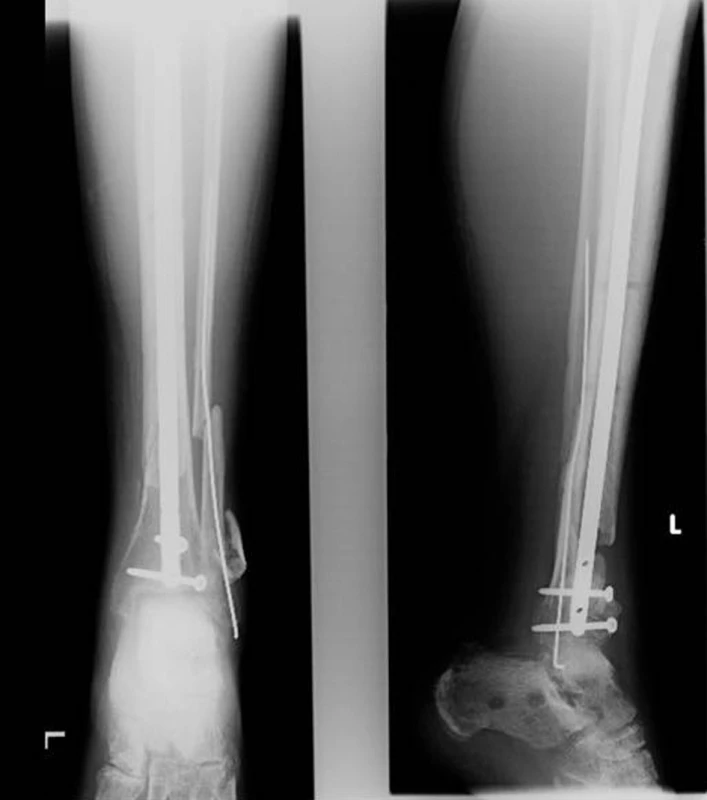 Konverze na intramedulární osteosyntézu pomocí expert tibial nail
Fig. 7: Conversion to intramedullary osteosynthesis using expert tibial nail