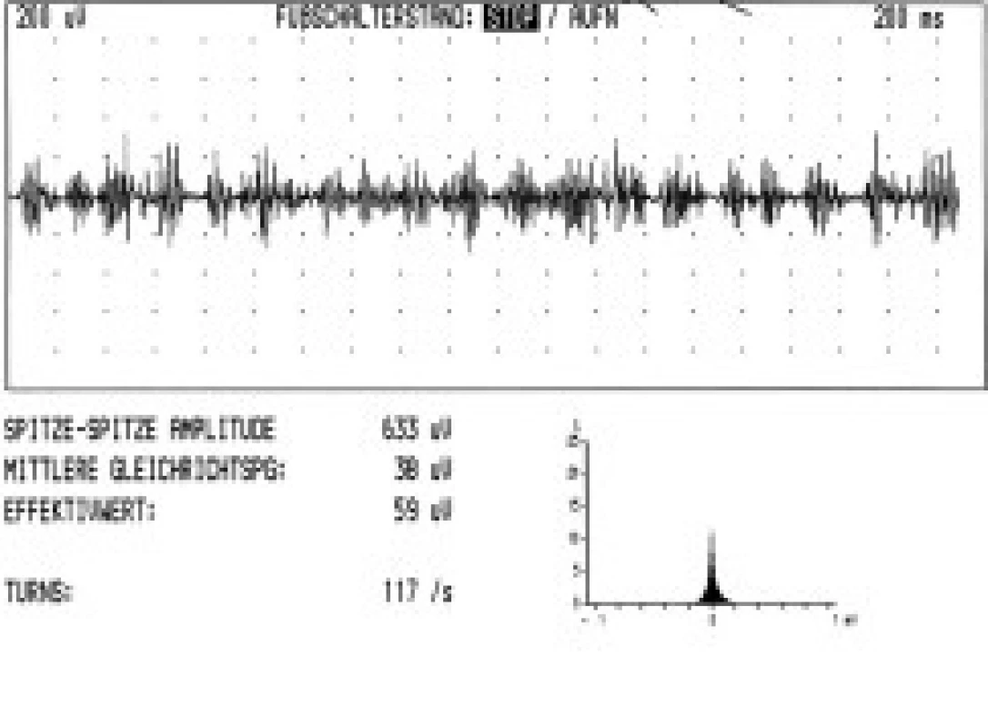 Turns/amplitude analysis u myoklonické formy cervikální dystonie v pokročilé fázi onemocnění (pravostranná torticollis, záznam z m. sternocleidomastoideus vlevo, participujícího svalu, počet turns/sekunda 117).