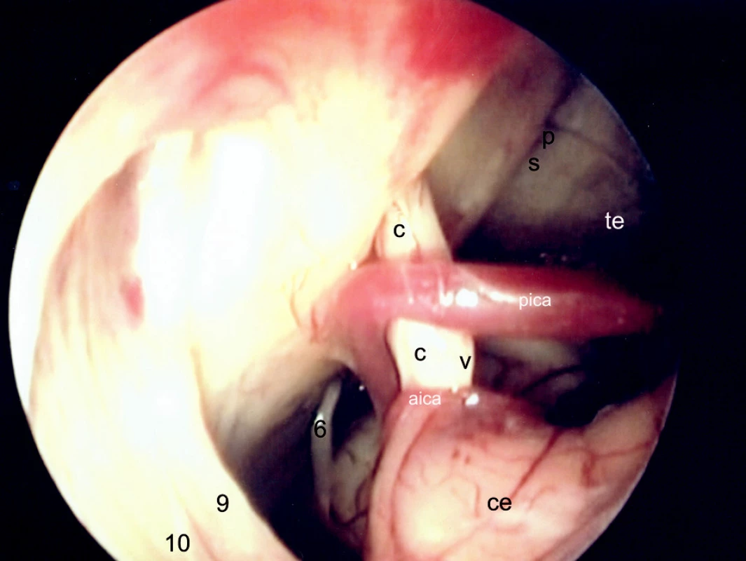 Endoskopia PC uhla vľavo. Pohľad najmä na strednú oblasť. Medzi nn. VIII a IX vidieť vpredu n. VI.