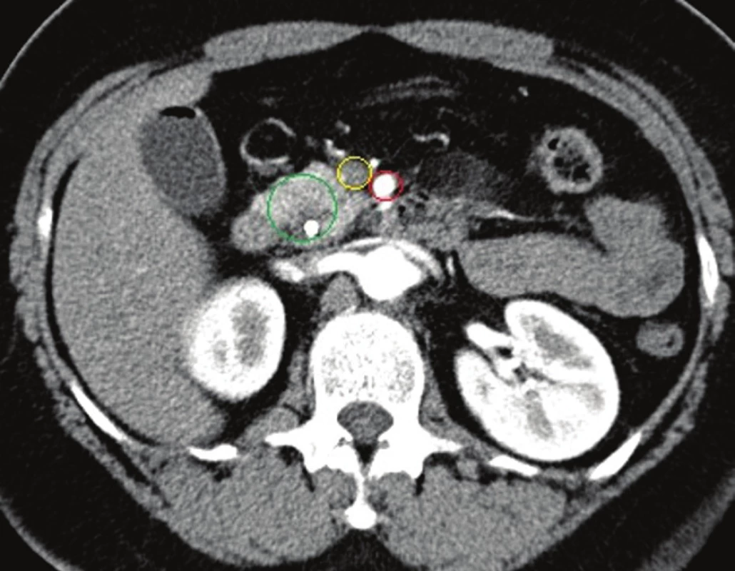 CT břicha, arteriální fáze, červený kruh: AMS, žlutý: VMS, zelený: tumor hlavy se stentem