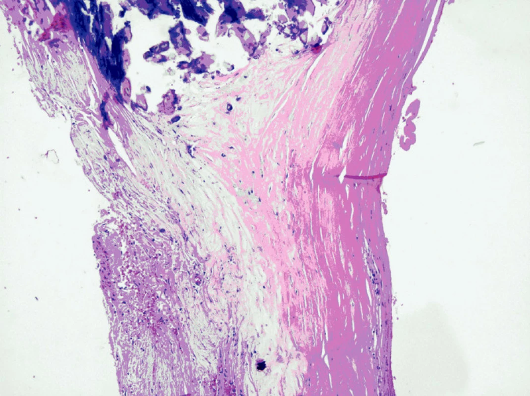 Histologický obraz stěny aneuryzmatu lienální tepny
Fig. 5. Histological findings of the aneurysmal wall of the lienal artery 