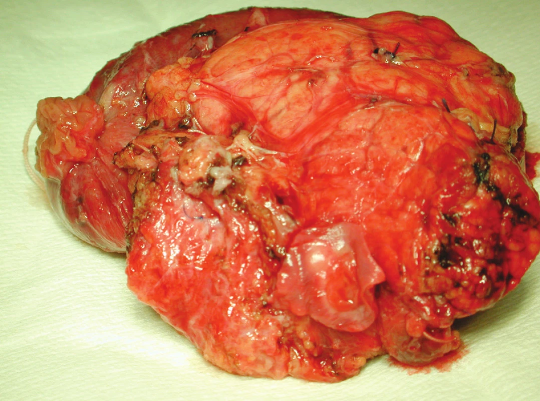 Resekovaná část hlavy slinivky břišní s prorůstáním tumoru do lumen cévy
Fig. 1. Aresected part of the pancreatic head with the tumor penetrating into the vascular lumen