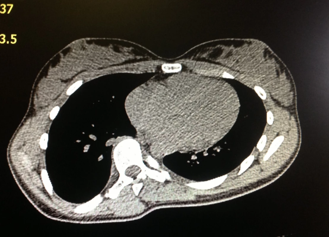 CT vyšetření – výrazná deformita hrudníku a rotace obratlů