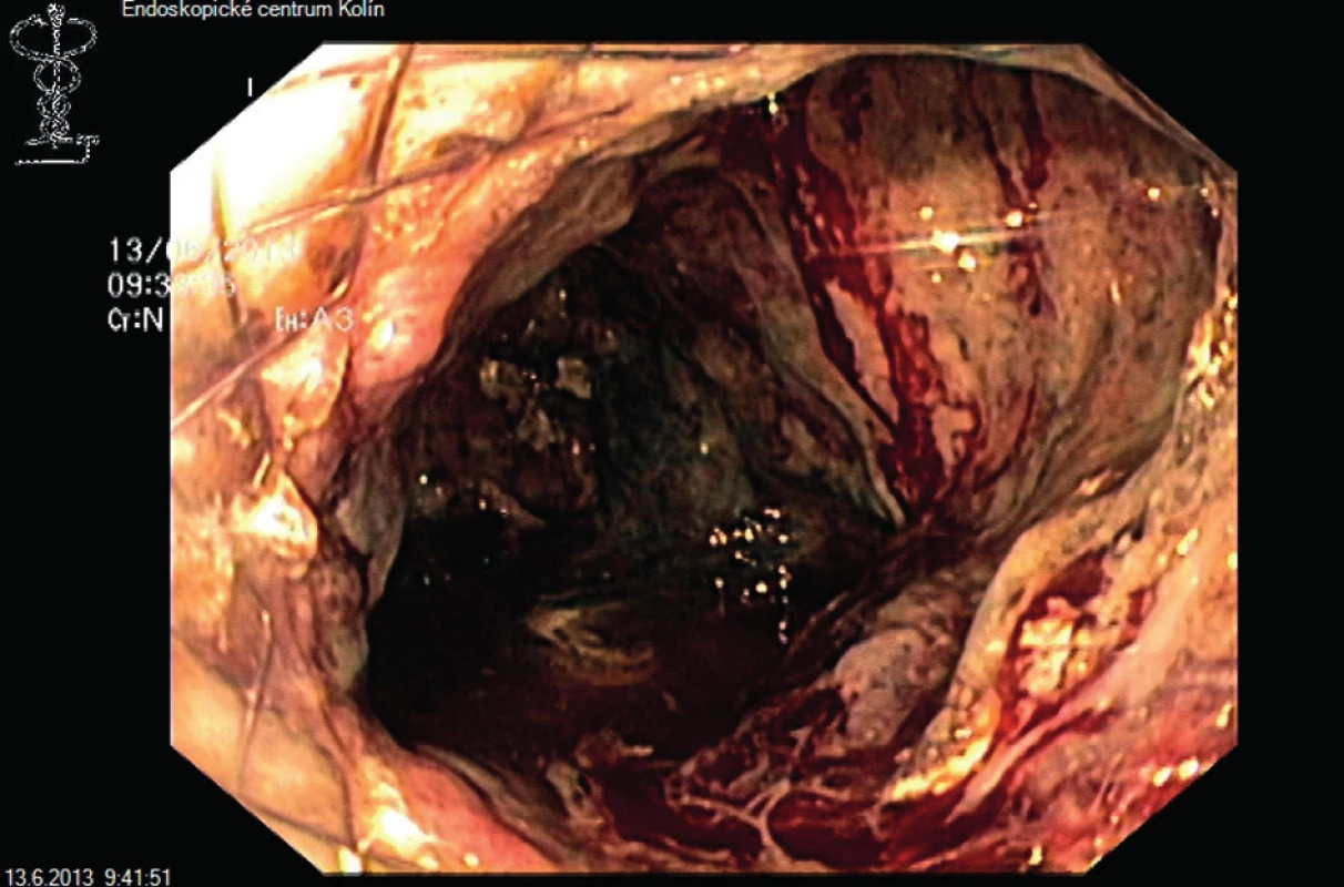 Videoasistovaná endoskopická perkutánní nekrektomie
Fig. 4: Video-assisted endoscopic percutaneous necrectomy
