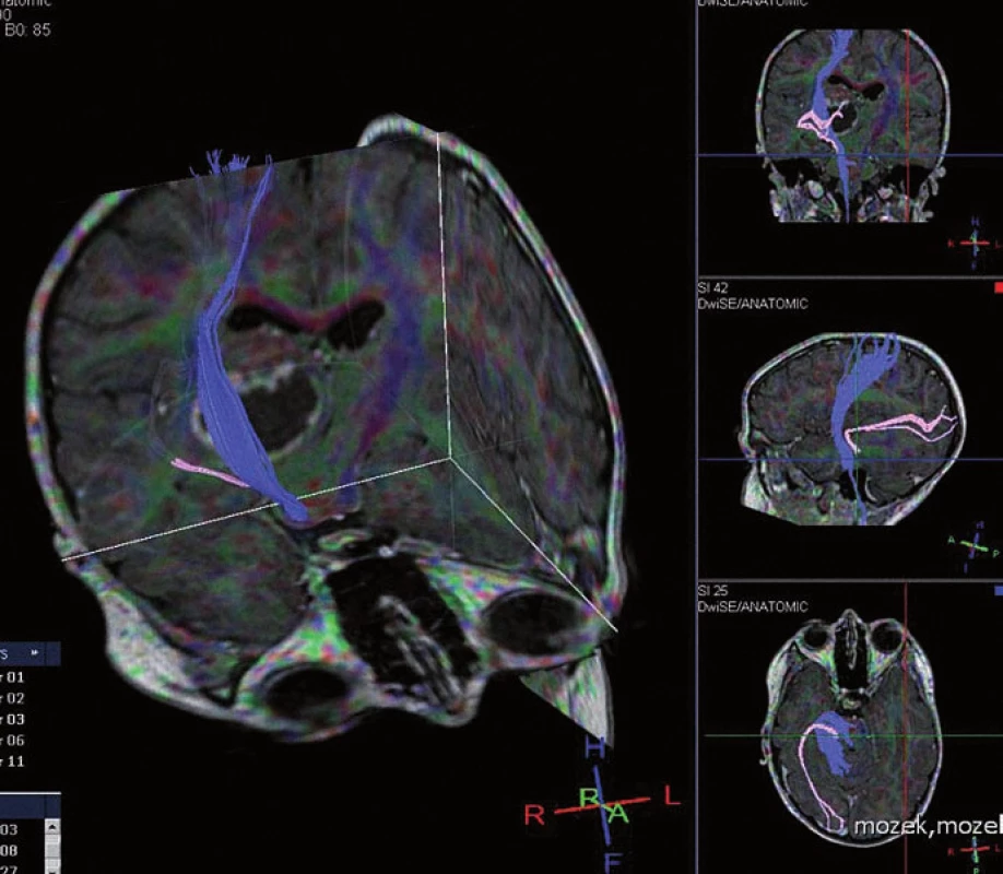 DTI (Diff usion Tensor Imaging) kortikospinální dráhy (modře) a zrakové dráhy (růžově) a jejich vztah k tumoru thalamu.