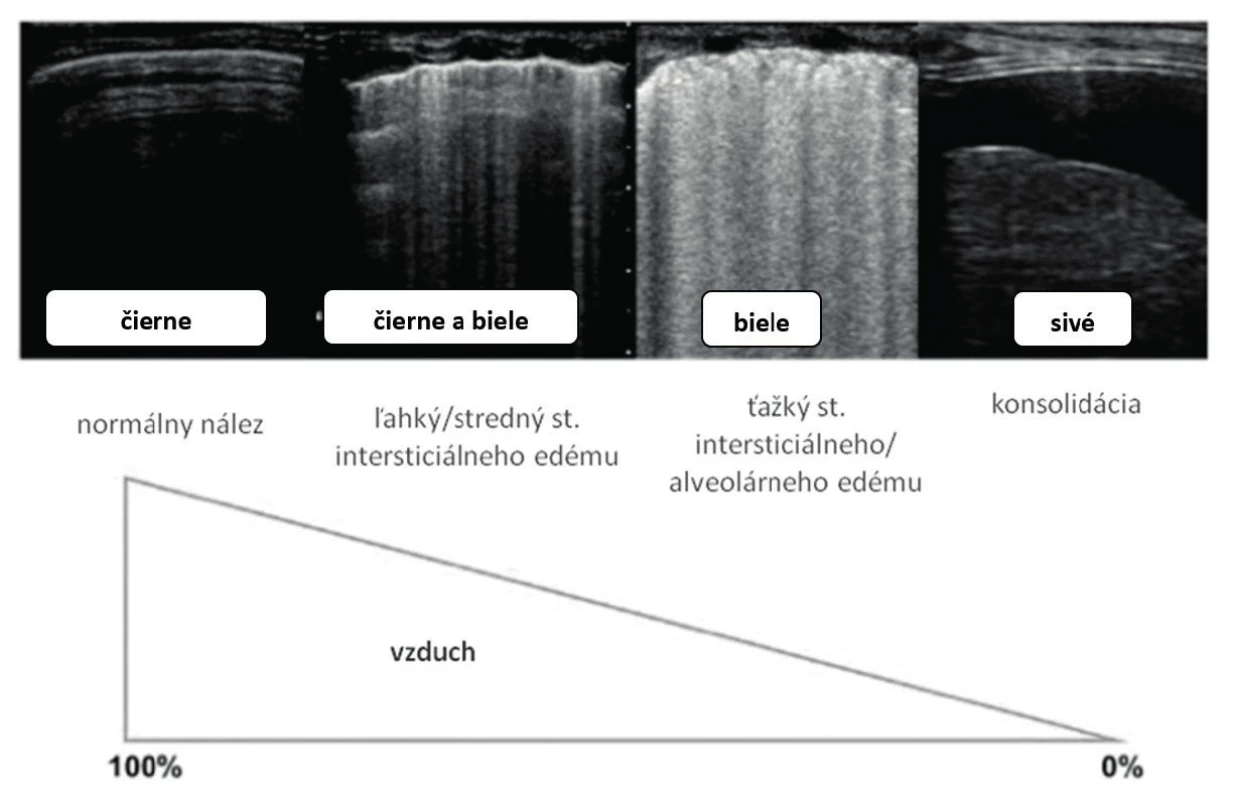 USG obraz pri meniacom sa pomere vzduch:tekutina. V ľavej časti obrázka vidíme normálny LUS nález tvorený len A-líniami (fyziologický nález). Pri postupne klesajúcom pomere vzduchu a narastajúcom obsahu vody dochádza k objaveniu sa B-línií – pri nižšom objeme od seba oddelených (B7- až B3-línie), neskôr splývajúcich do celku (biele pľúca – Birolleauov variant). V pravej časti obrázku vidíme obraz komprimovaných nevzdušných pľúc (echogénna časť) pri pleurálnom výpotku (anechogénna časť), upravené podľa [4].
Fig. 4. LUS image in changing air:fluid ratio. In left part of the picture normal LUS with A-lines shown (physiologic finding). With further fluid progression (air decreasing and fluid increasing) B-lines occur with variability from B7 to B3-lines to diffuse picture (Birolleau variant). On the right side of picture consolidated airless lungs (echogenic part) with plerual effusion (anechogenic part) are visible, modification by [4].