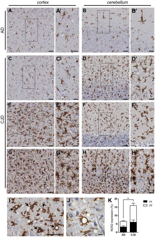 NOX2 expression is increased in affected brain regions of CJD patients.