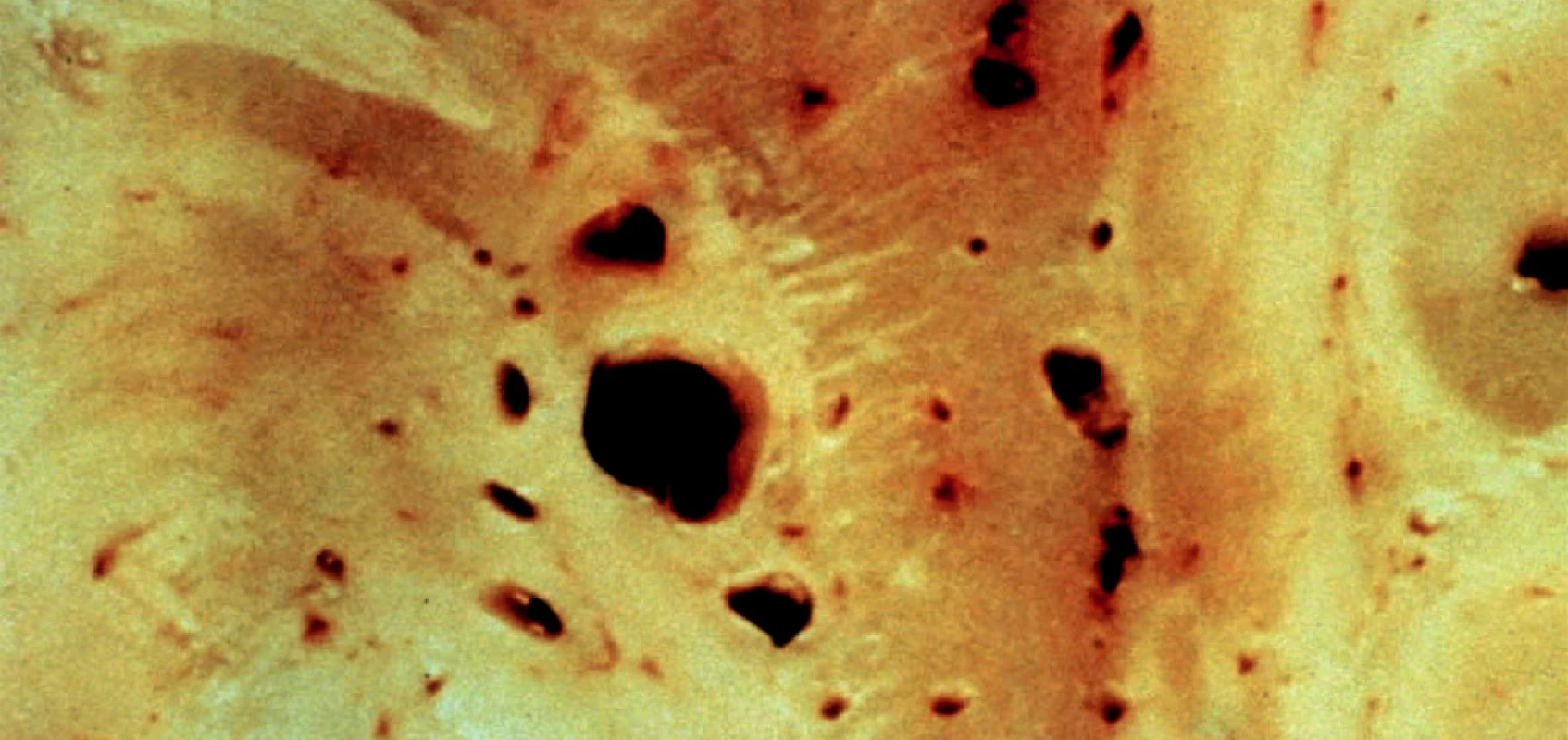 Lakuny (větší dutinky) a cribra (menší dutinky) bazálních ganglií. Lakuna je postmalatická
pseudocysta do průměru 10 mm. Cribrum je dutinka vytvořená mechanicky pulzem tepének.