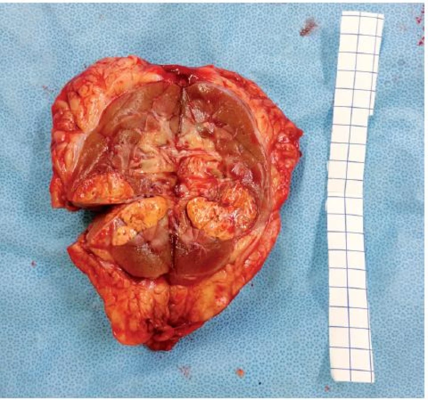 Tumor ledviny, fotografie preparátu po radikální nefrektomii 
Fig. 5. Renal tumor, photography of preparate after radical nefrectomy