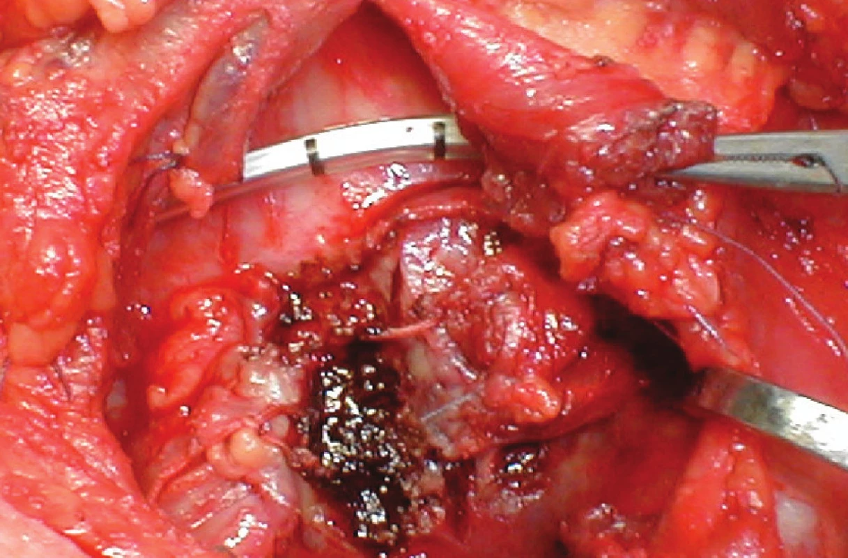 Obr. 3: Paliativní resekce istmu štítné žlázy
Fig. 3: Paliative resection of the thyroid isthmus
