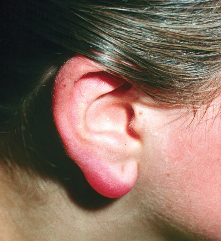 Lymfocytom na uchu