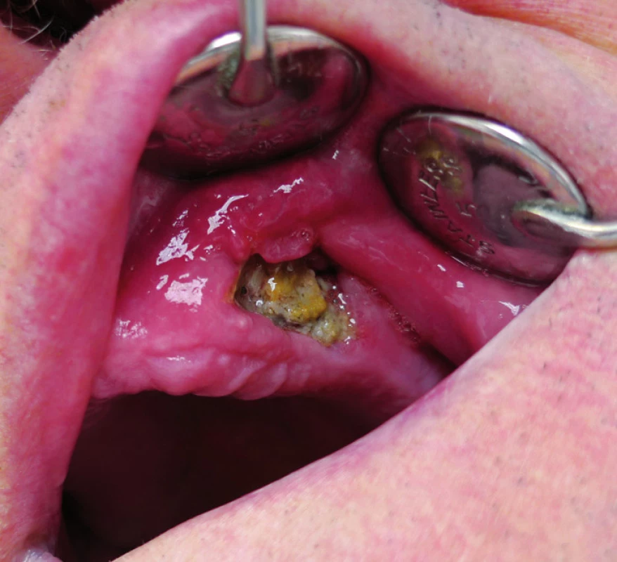 Osteonekróza horní čelisti (II. stadium) vzniklá po extrakci zubu u pacienta s generalizovaným dobře diferencovaným konvenčním renálním karcinomem s přechodem do vysoce maligního sarkomatoidního renálního karcinomu s rabdomyoblastickou diferenciací. Pacient byl mimo jiné dlouhodobě léčen bisfosfonáty (50 měsíců klodronát, 4 měsíce zoledronát, 2 měsíce pamidronát) v konkomitanci s biologickou léčbou (7 měsíců sorafenib).
Fig. 3. Osteonecrosis of the maxilla (the 2nd stage) arised after tooth extraction in the patient with metastatic well- -diff erentiated conventional renal cell carcinoma with high-grade transformation into sarcomatoid renal cell carcinoma with rhabdomyoblastic diff erentiation. The patient received long term bisphosphonate therapy (clodronate for 50 months, zoledronate for 4 months, pamidronate for 2 months) and concomitant biological therapy (sorafenib for 7 months) among other things.