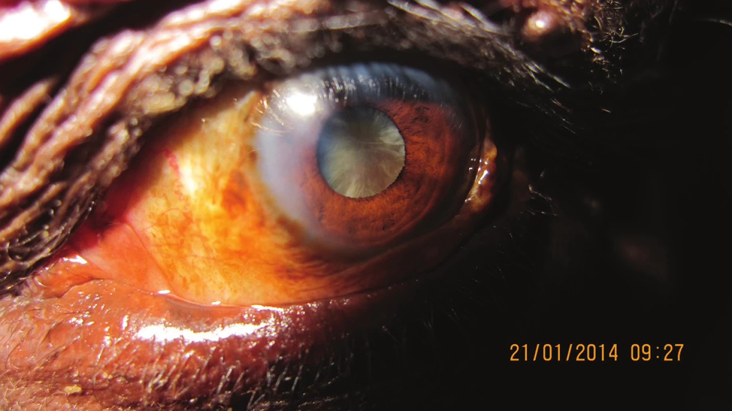 Makrofoto predného segmentu oka pacienta s kataraktou