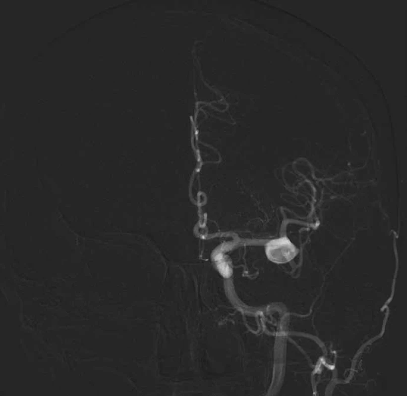 Digitální subtrakční angiografie potvrdila nález široce nasedajícího aneuryzmatu ve větvení M1/2 vlevo s fundem směřujícím dopředu. Krček aneuryzmatu je široký 8 mm.