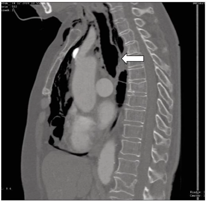 Druhý případ, CT vyšetření asi 3 hod od poranění prokazuje pneumomediastinum a pneumocolum, patrná asi 30 mm dlouhá trhlina pars membranacea v distální části trachey (šipka)