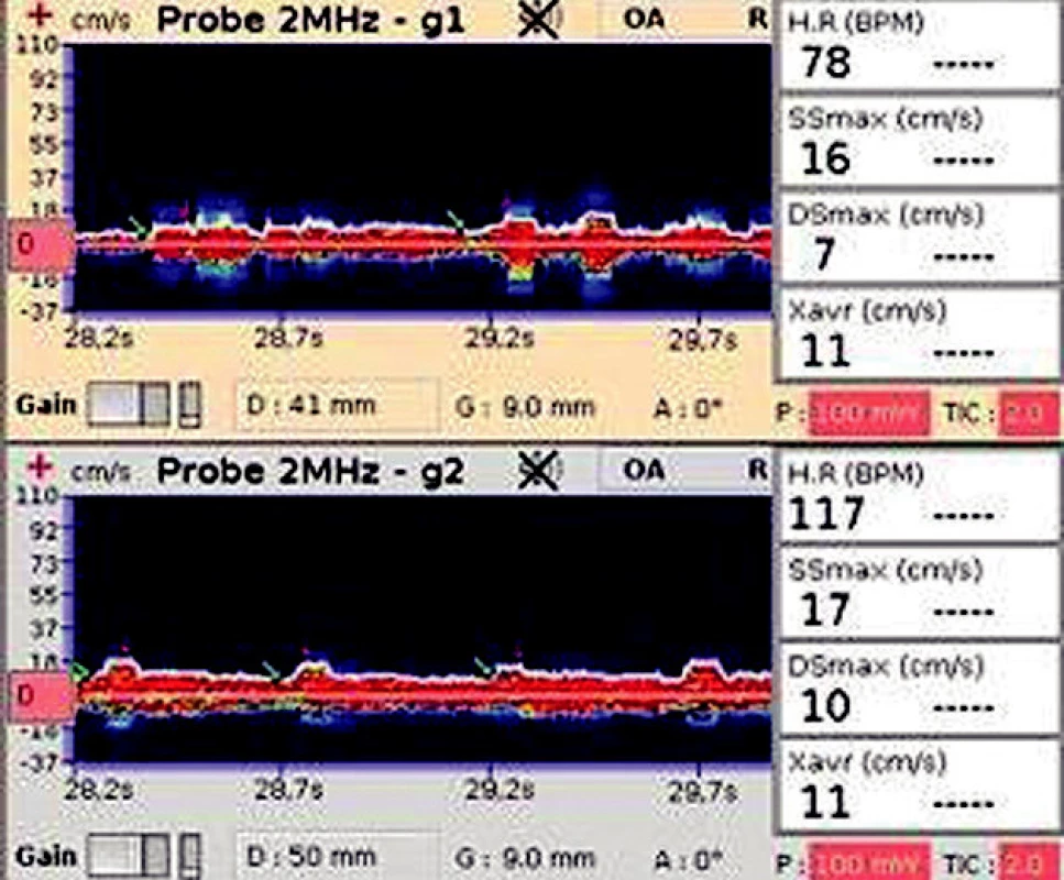 TCD záznam na a. opthalmica zobrazuje nízkou maximalní systolickou a diastolickou rychlost (SSmax, Dsmax) a nízkou průměrnou maximální rychlost (Xavr)