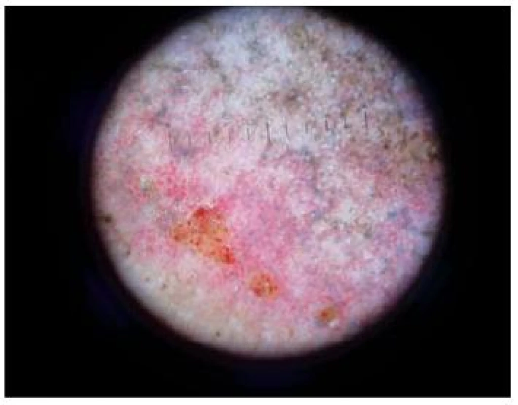 Stasis dermatitis, hemosiderinové pigmentace
(Obrázek – MUDr. Ivana Strouhalová)